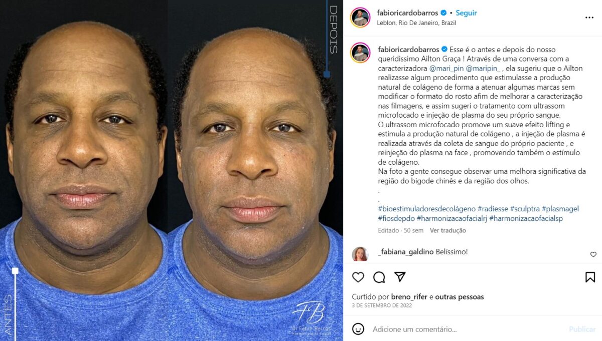 Aílton Graça faz Harmonização Facial para viver Mussum em filme premiado